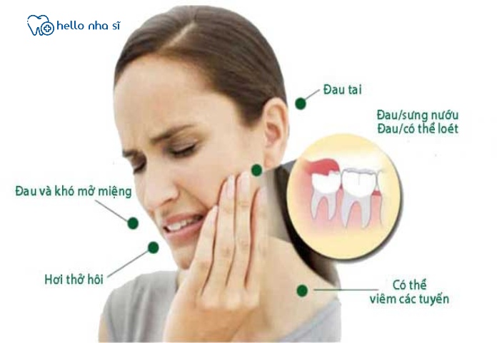 Răng khôn mọc lệch chính là nguyên nhân gây nên tình trạng đau nhức.