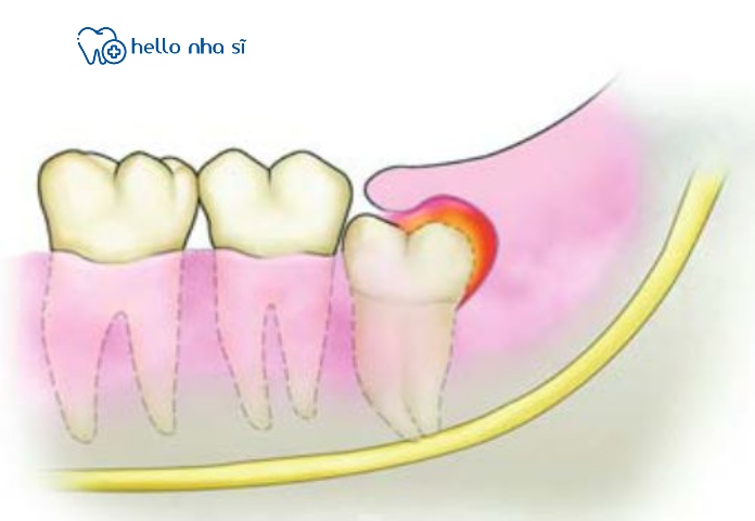 Chi phí cắt lợi trùm sẽ tùy thuộc vào tình trạng của bạn