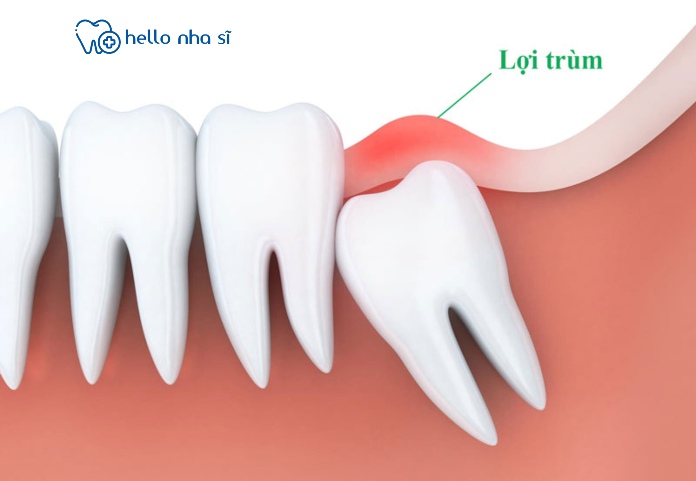 răng khôn mọc lệch gây viêm nhiễm dẫn tới viêm nướu trùm