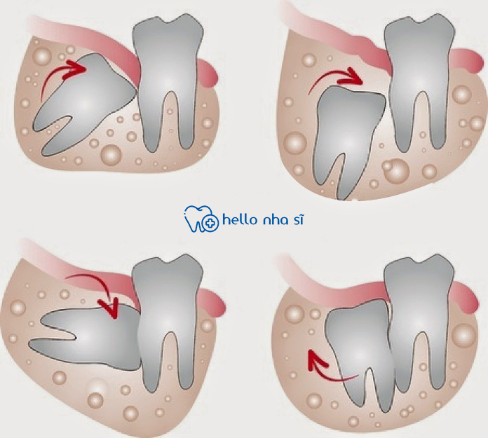 Chí phí để nhổ răng khôn còn tùy thuộc vào vị trí mọc và tình trạng của răng khôn