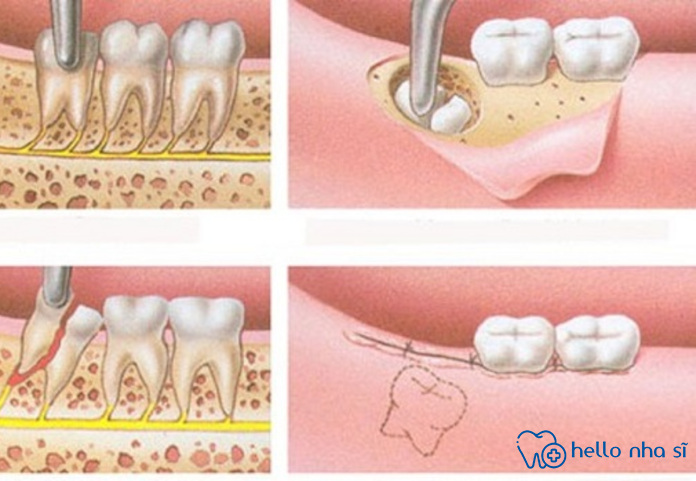 Khi nhổ răng khôn thì bạn chỉ bị đau nhẹ ở mức độ bạn có thể chịu được