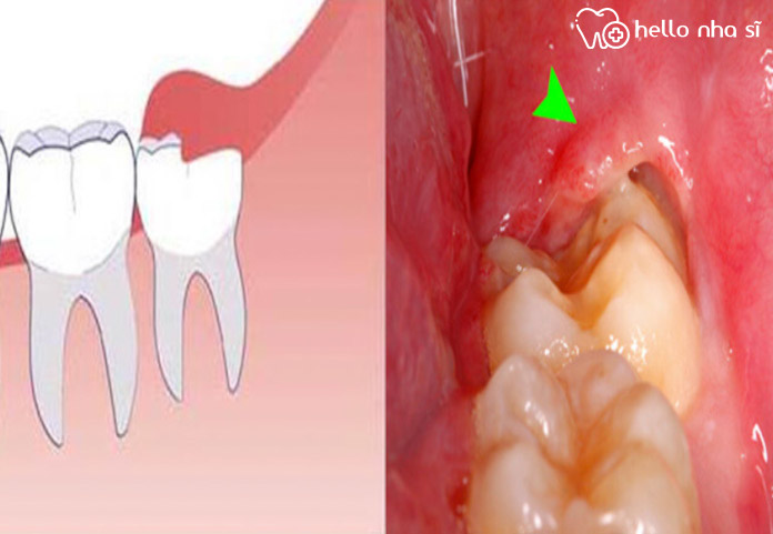 Răng càng mọc lớn càng dồn ép lại dần khiến chúng dễ tổn thương.