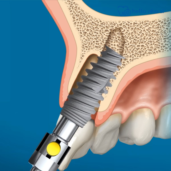 Tích hợp xương nhanh chóng từ Implant Nobel