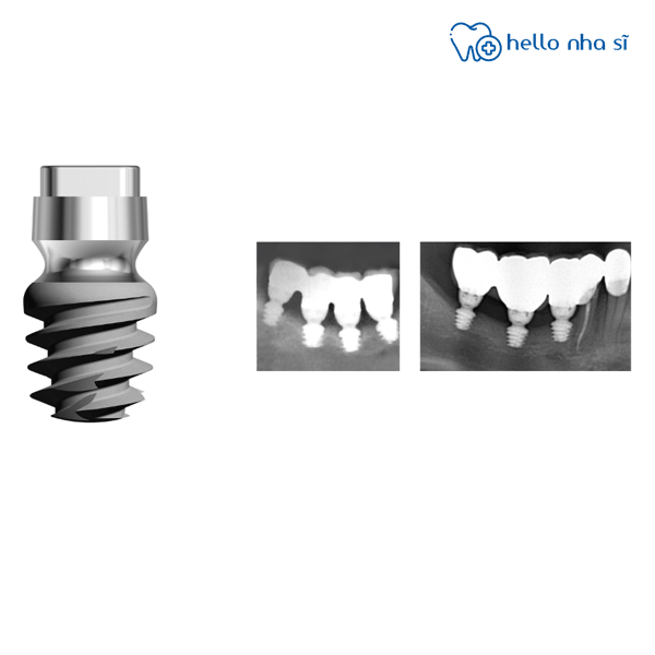 Cần chụp CT để trồng răng chính xác