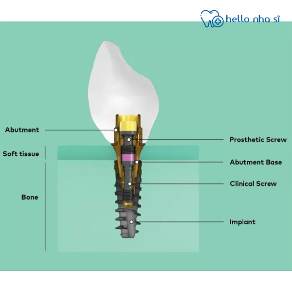 Cấu trúc implant Nobel