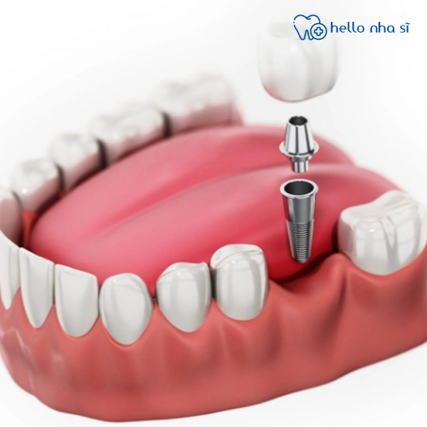 Cấy ghép Implant cho răng mất 1 chiếc