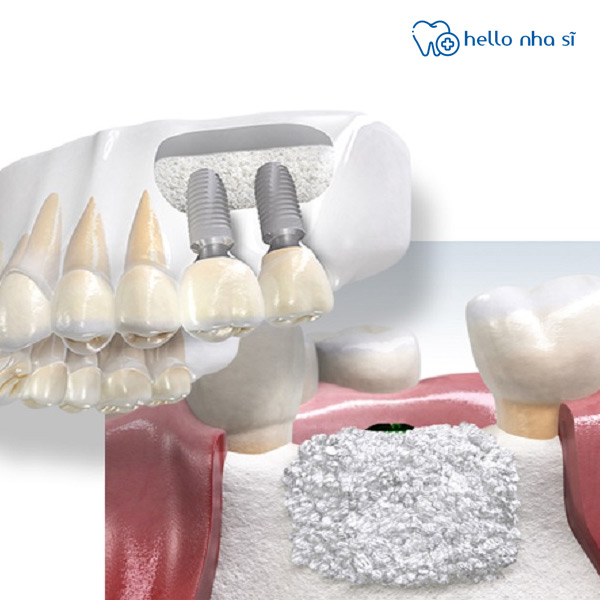 Khả năng tái tạo xương quyết định thời gian hoàn thiện cấy implant