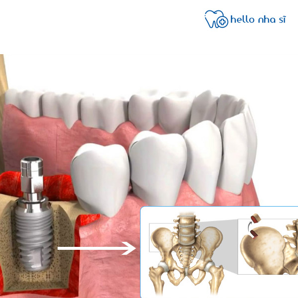 Bột xương tự thân