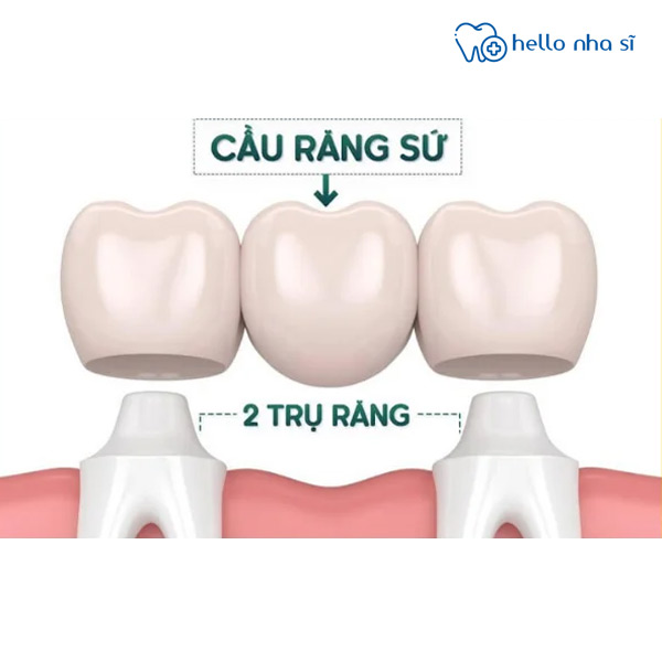 Bắc cầu răng sứ cũng là phương pháp giải quyết vấn đề mất một răng