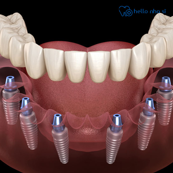 Cấy ghép Implant toàn hàm All-on-6