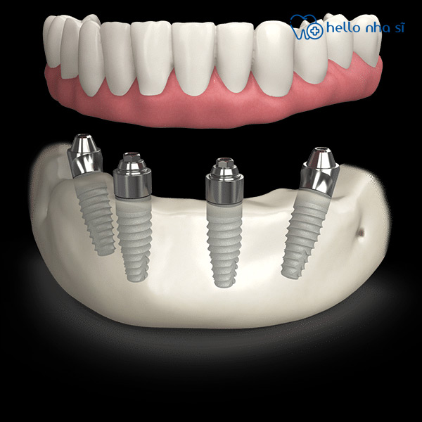 Cấy ghép Implant toàn hàm All-on-4